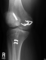 ACL intereference screws